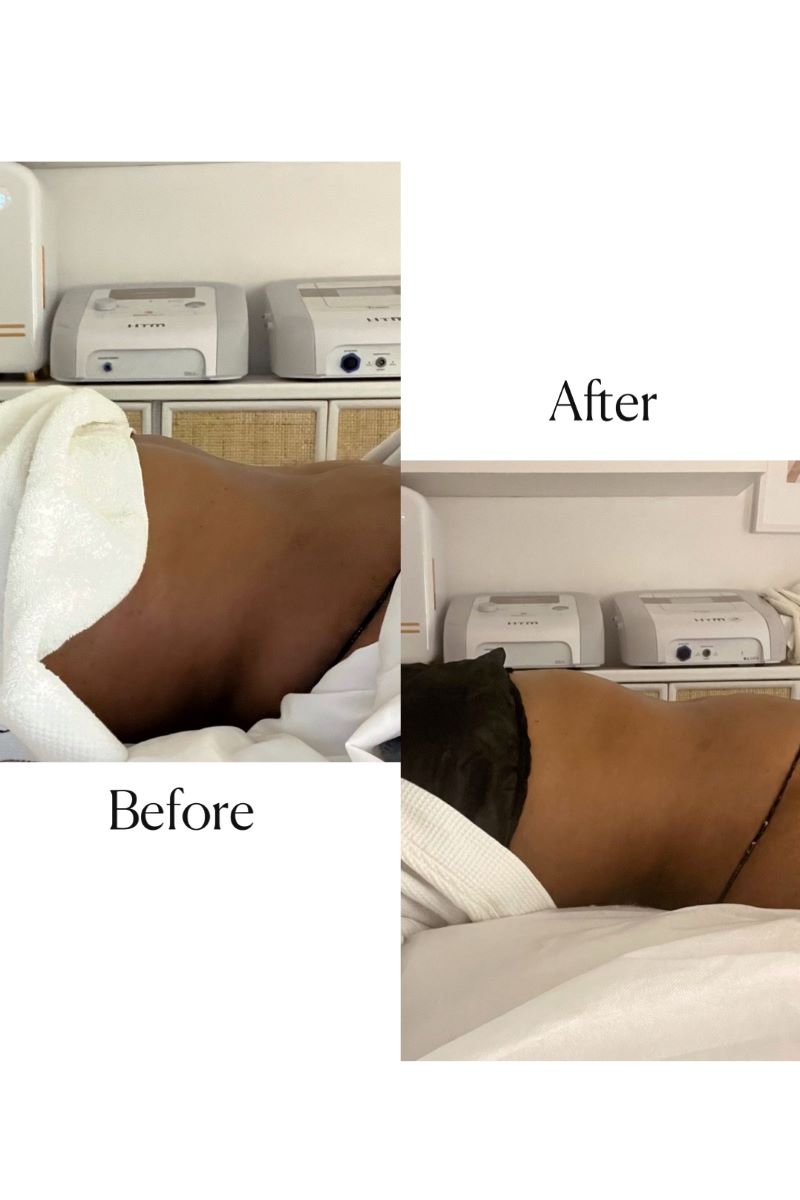 Before and After Lymphatic Massage Results